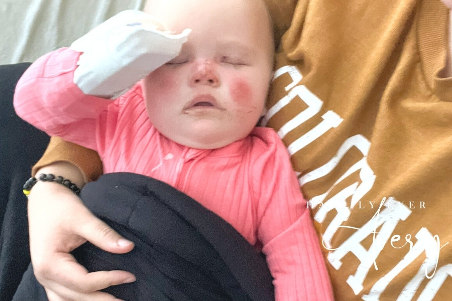 infant with blisters on face due to itching after bmt